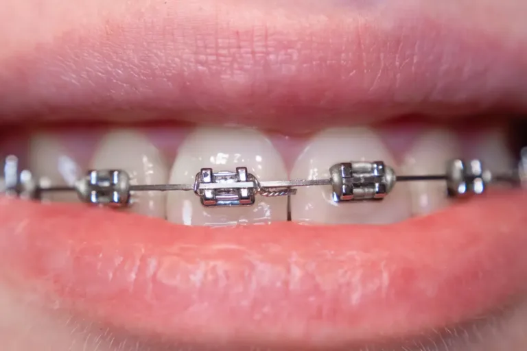 Aparat ortodontyczny w 2026 roku co nowego w prostowaniu zebow
